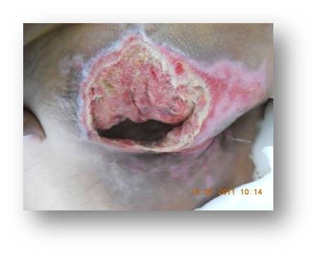 Abdominal Dehiscence