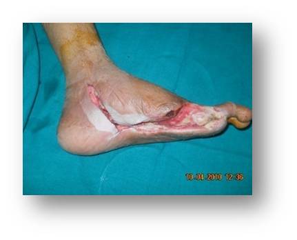 Diabetic Foot Ulcer