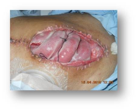 Abdominal Dehiscence